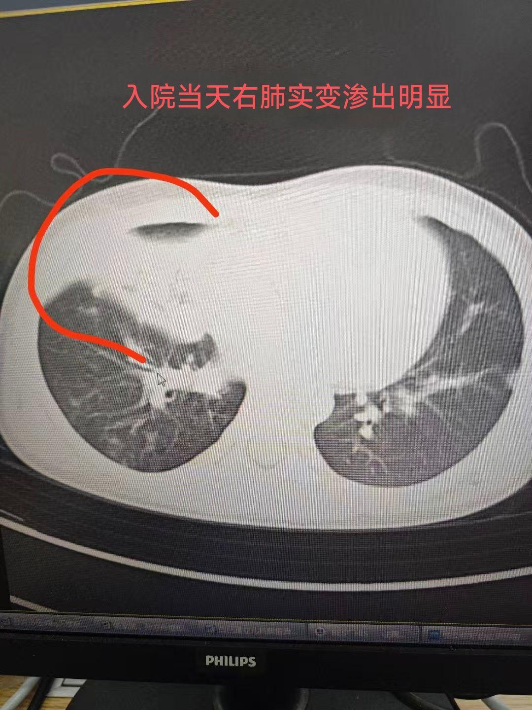 “张家口新型肺炎” 河北省张家口市新型肺炎？-第2张图片
