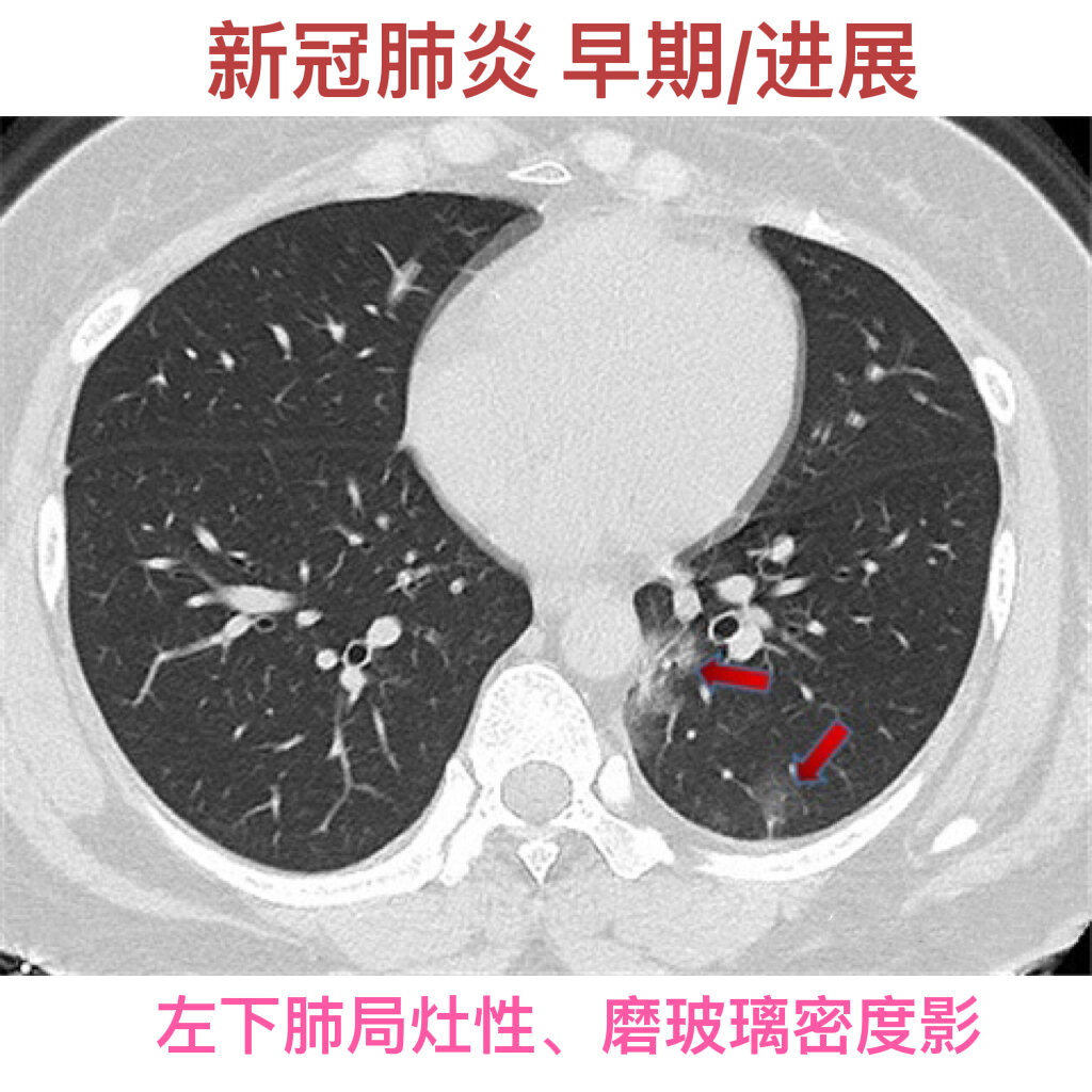 浙江省新型肺炎︰(浙江省 新冠)-第1张图片