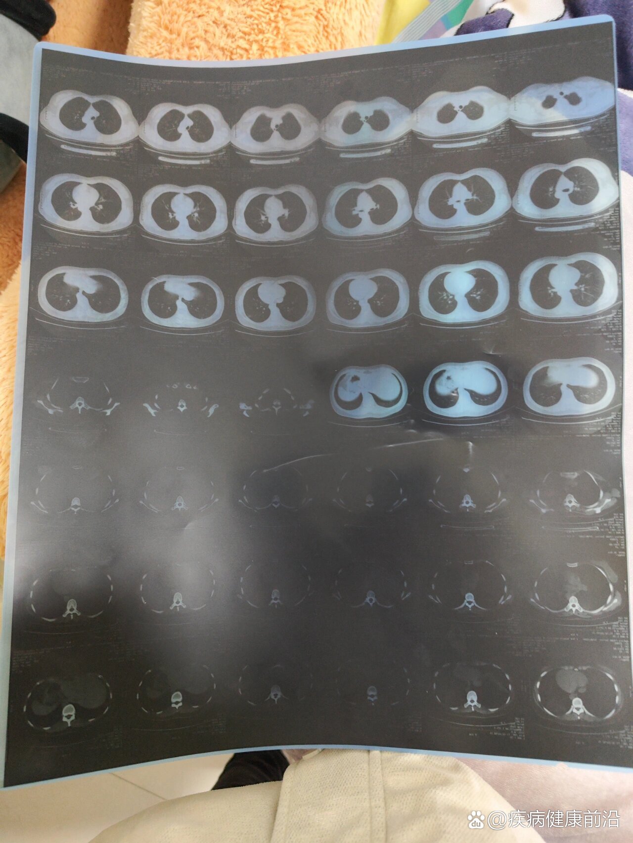 “新型肺炎确诊病例	” 新型病毒确诊病例？-第2张图片